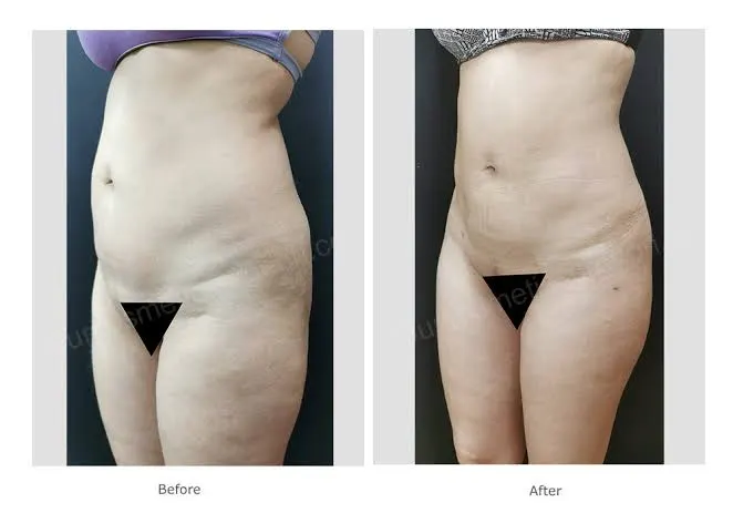 Abdominoplasty / Liposuction