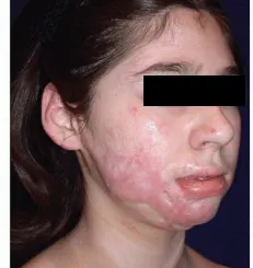 Before burn care treatment