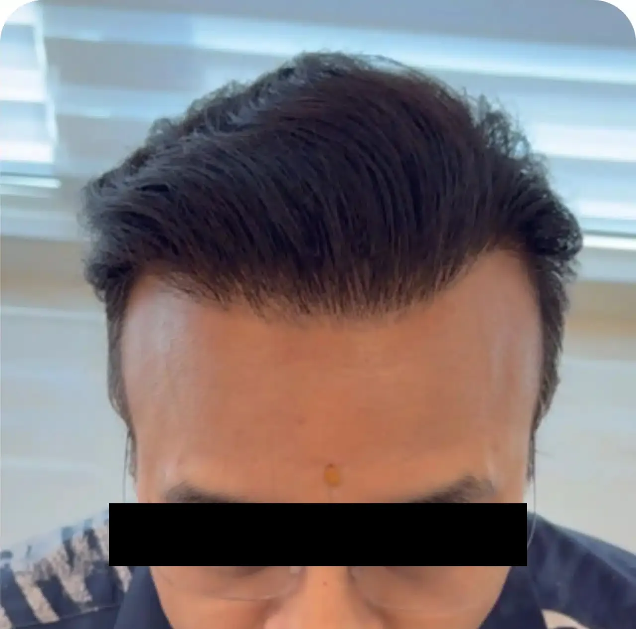 After hair transplant