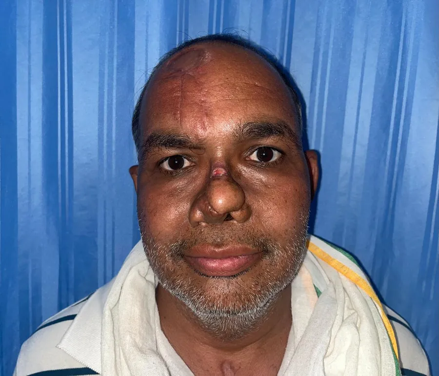 After nasal reconstruction