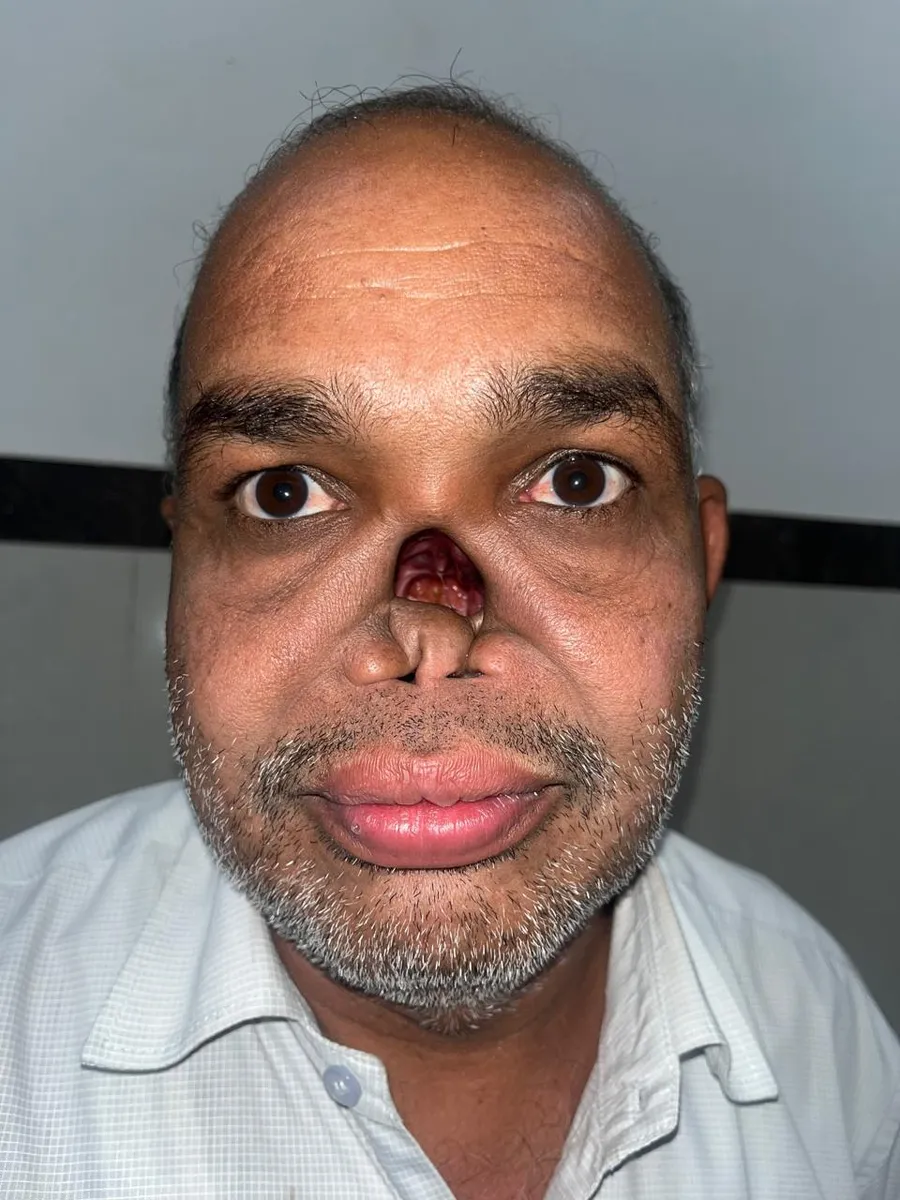 Before nasal reconstruction