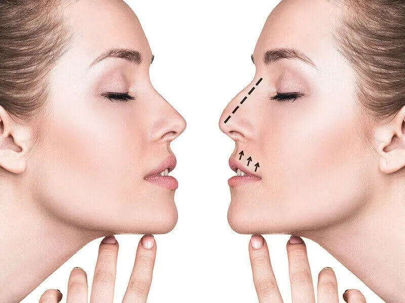 Rhinoplasty